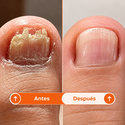NOREVEX: El aceite que elimina el 99.9% de los hongos en tus uñas.